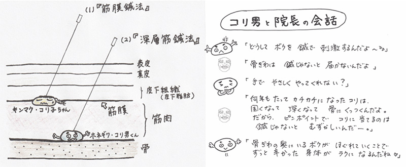 深層筋鍼法